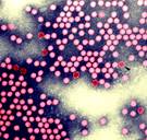 ‘Kreupel’ poliovirus blijkt effectief tegen agressieve hersentumor