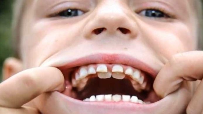 schuifelen Premedicatie Verleiden Deze jongen heeft dubbele rij tanden (net zoals haaien) | Buitenland |  hln.be