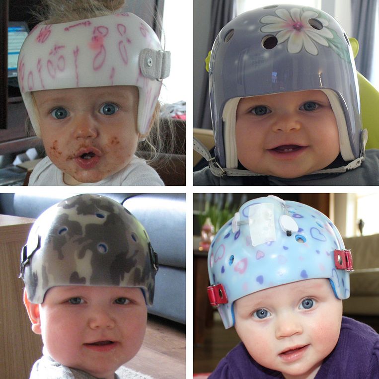 Belastingen Gering solide Helm is helemaal niet nodig voor correctie babyschedel | De Volkskrant