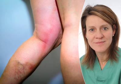 “Have varicose veins treated, they can lead to phlebitis”: vascular specialist explains annoying condition