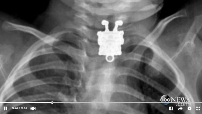 Op de röntgenfoto is duidelijk te zien dat het poppetje Sponge Bob Square Pants is ingeslikt.