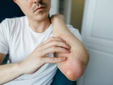 Last van eczeem? Een expert geeft tips