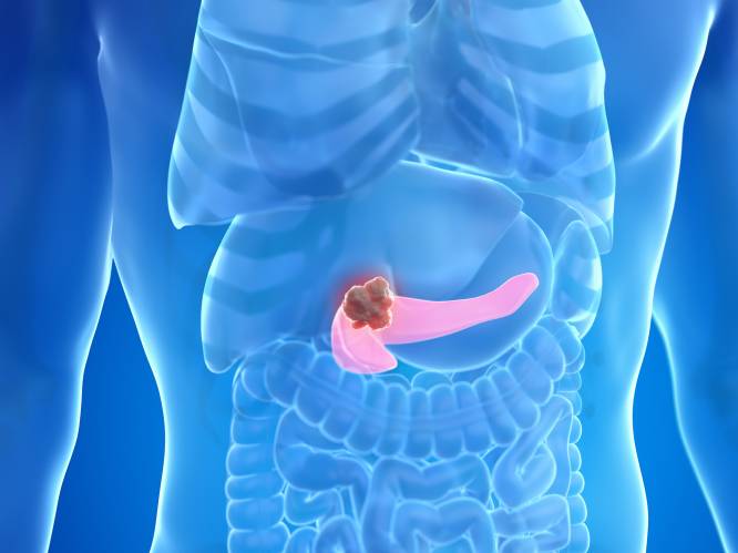 Na doorbraak in strijd tegen pancreaskanker: wat zijn de symptomen en hoe wordt de kanker nu al behandeld?