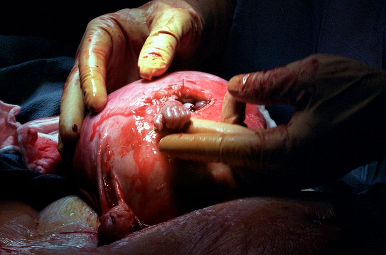 De beroemde foto van een foetale operatie in de VS. Het LUMC werkt alleen via kijkoperaties. ‘Wij maken de buik niet open, want dat is een enorme aanslag op de gezondheid van de moeder.’ Beeld Michael Clancy