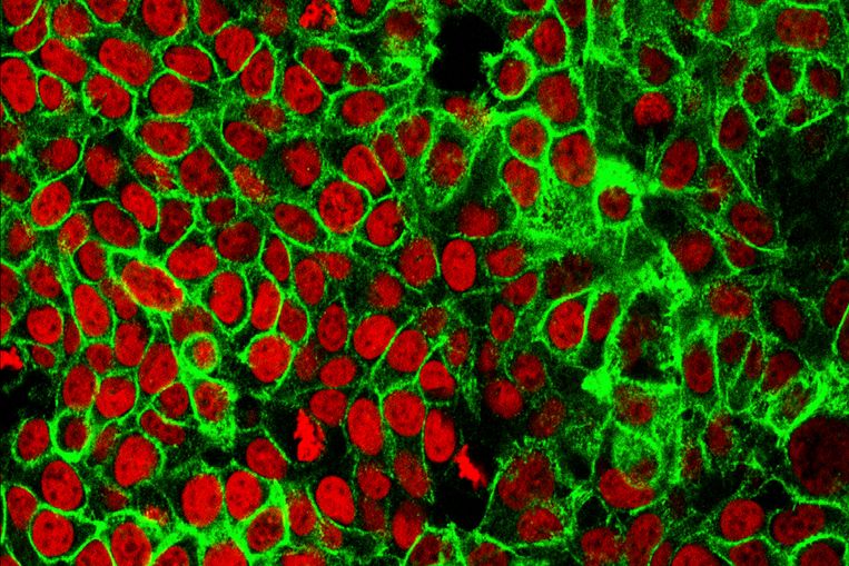 Darmkankercellen onder de microscoop. De kankercellen zijn in rood weergegeven. Beeld AP