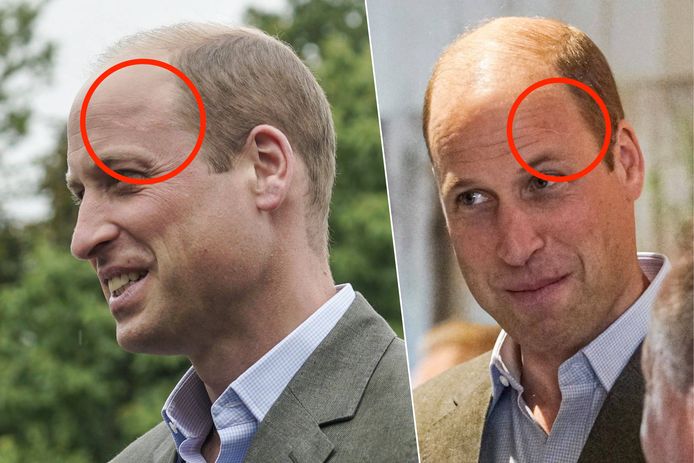 De foto's die deze week van prins William gemaakt werden, tonen zijn ‘Harry Potter’-litteken.