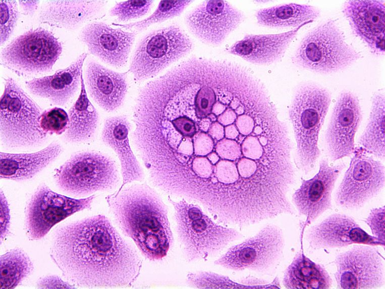 HPV, het virus dat baarmoederhalskanker kan veroorzaken, onder een microscoop. Beeld Getty Images/Image Source