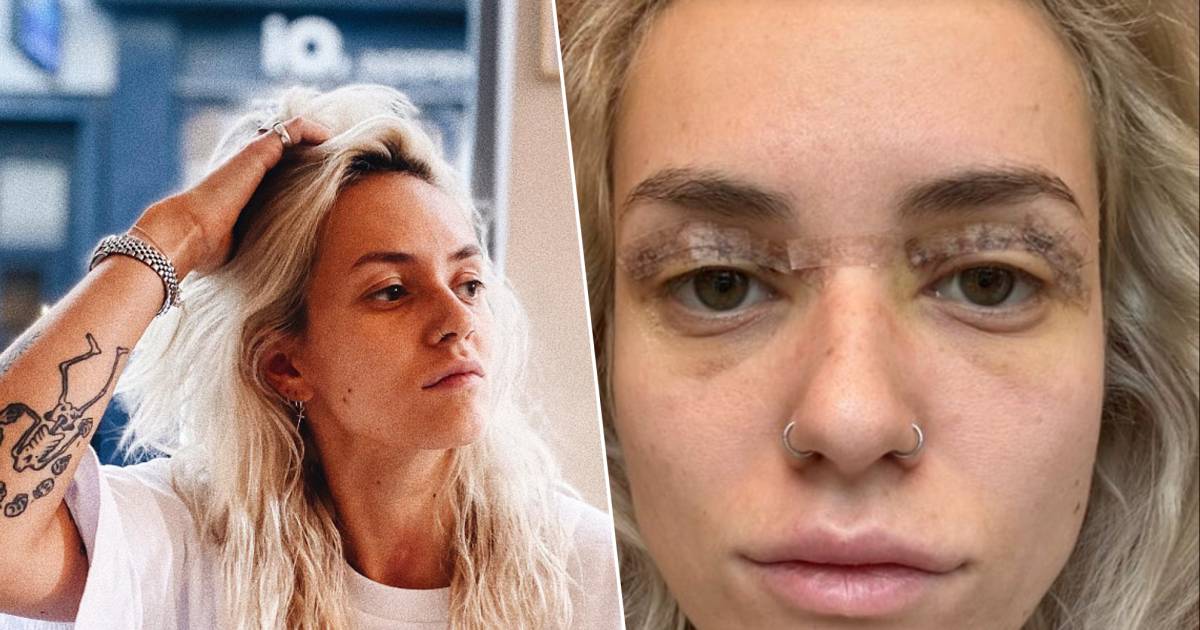 Jitske Van de Veire had eyelid correction: “It looks black and blue” |  BV