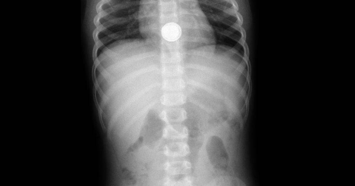 Kinderartsen Slaan Alarm Om Knoopcelbatterij Gezond Ad Nl