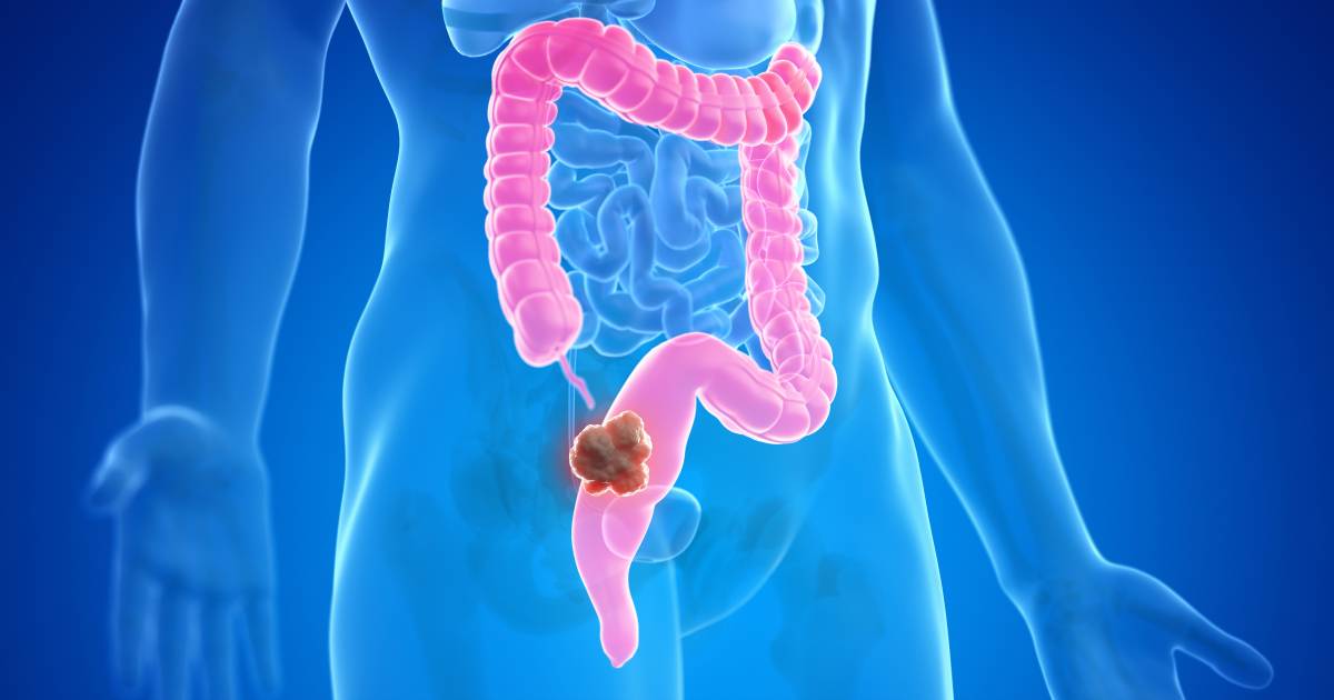 結腸がんを検出するための新しい検査により、数千人の患者が救われる可能性がある | 健康