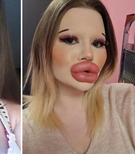 Cette influenceuse bulgare veut se transformer en poupée Bratz: après une trentaine d'injections aux lèvres, elle s’attaque à ses pommettes