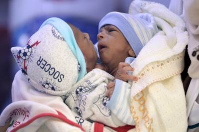 Des bébés siamois dans un état critique évacués du Yémen en Jordanie