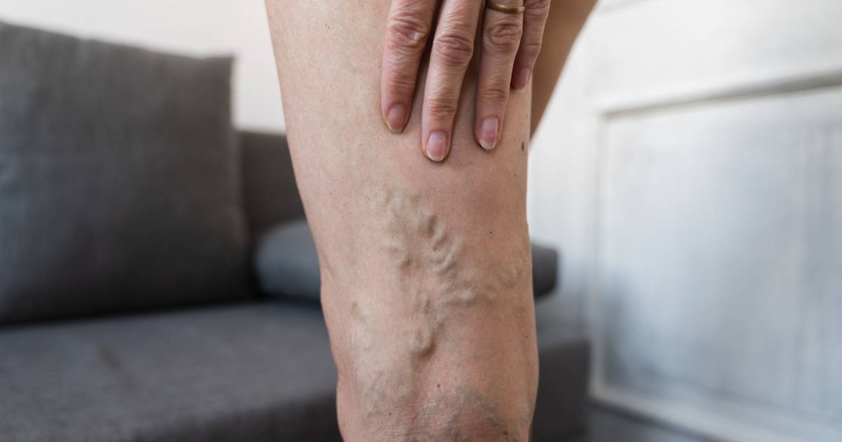 Dermatoloog: ‘Een zalf die spataderen doet verdwijnen? Dat is ...