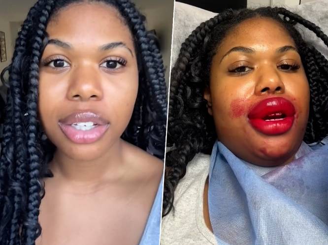 Influencer laat lippen tatoeëren, maar krijgt daar al snel spijt van