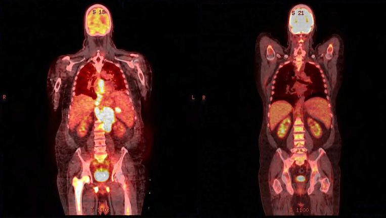 Met een beetje radioactiviteit kun je zien wat een medicijn in je lichaam doet. Links is een tumor te zien, die is rechts verdwenen. Dit zijn niet de scans waar biochemicus Guus van Dongen mee werkt. Beeld .