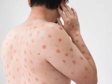 La Belgique recense 726 cas de variole du singe: presque uniquement des hommes
