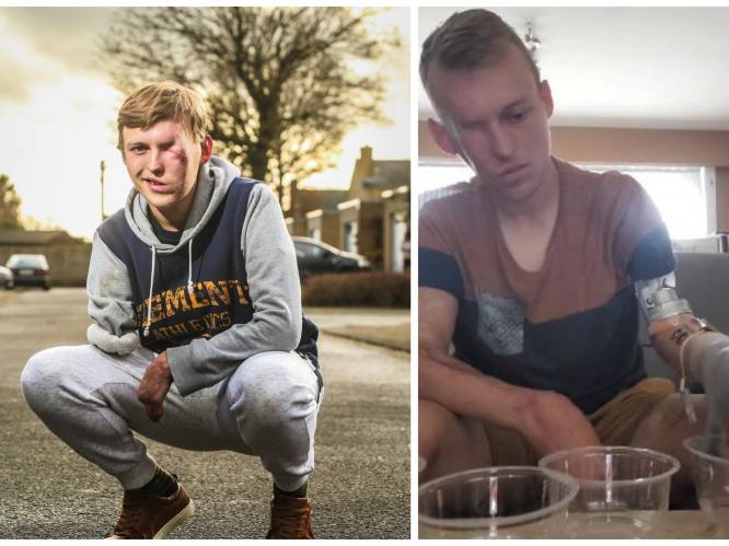 KIJK. Joeri (25) raakte zwaar verminkt bij dodehoekongeval met vrachtwagen, nu toont hij wat hij kan met zijn bionische prothese