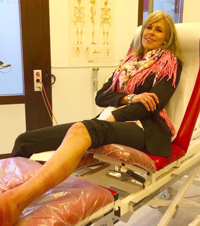 Marga Bult nadat het eerste gips werd verwijderd.