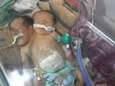 Schrijnend: Siamese tweeling kan Jemen niet uit voor behandeling en sterft<br>