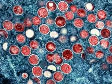 Plus de 60 cas de variole du singe signalés en Belgique en une semaine