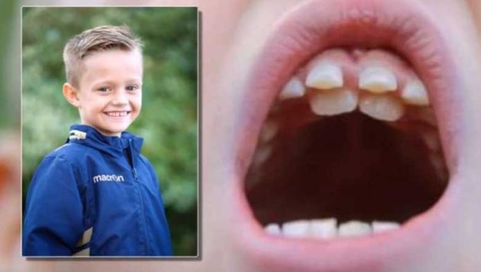 schuifelen Premedicatie Verleiden Deze jongen heeft dubbele rij tanden (net zoals haaien) | Buitenland |  hln.be
