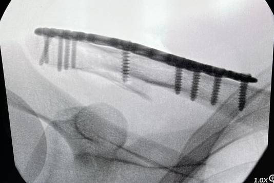 Jasper Stuyven deelde een foto van het ijzewerk dat in z'n sleutelbeen werd gestopt.