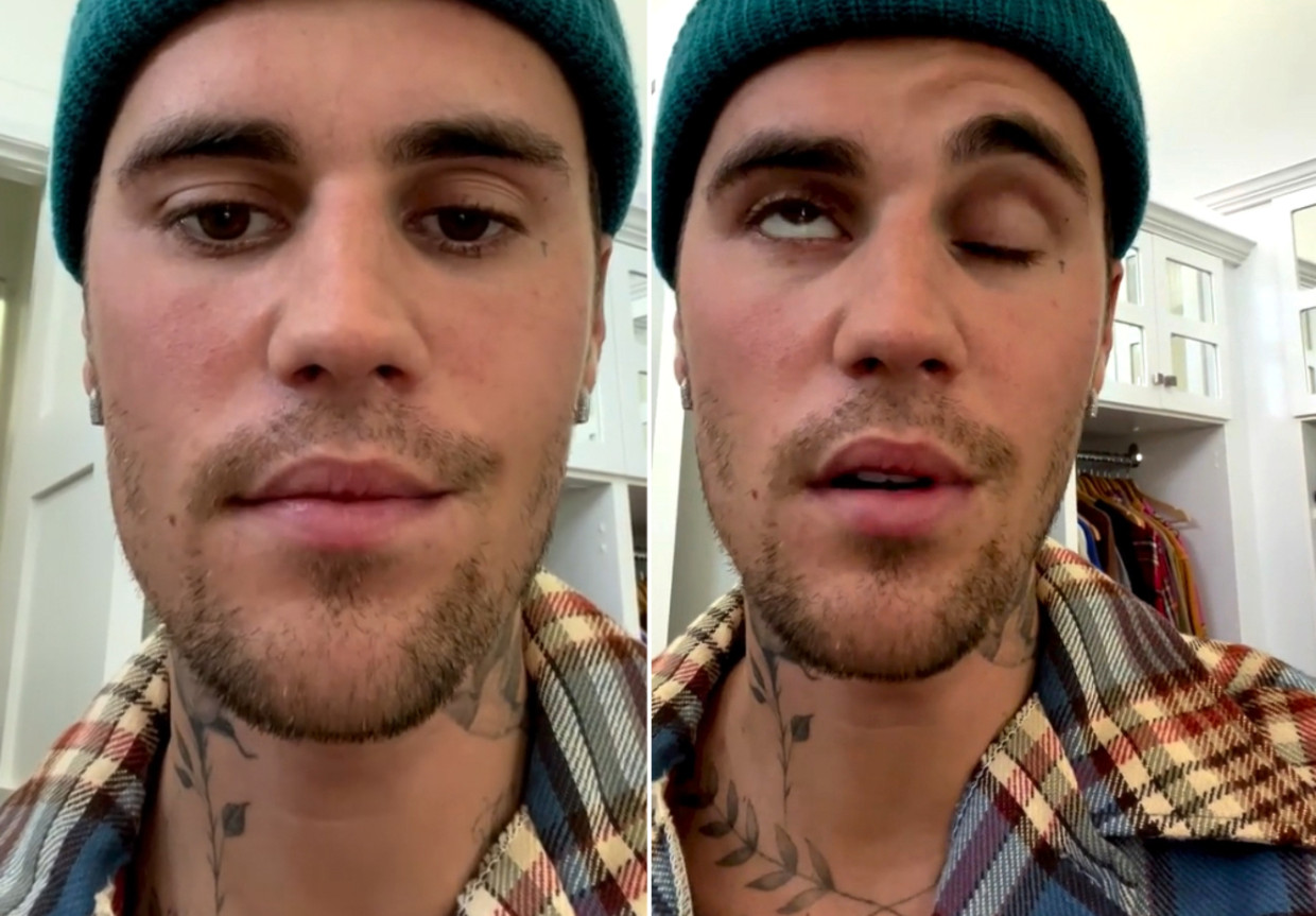 Justin Bieber kampt met het syndroom van Ramsay-Hunt. Beeld Instagram