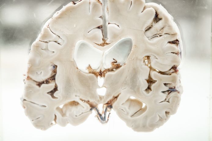 Een alzheimerbrein is kleiner dan dat van een gezond persoon.