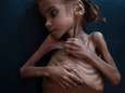 Uitgemergeld Jemenitisch meisje van wie foto de wereld rondging, is gestorven van de honger
