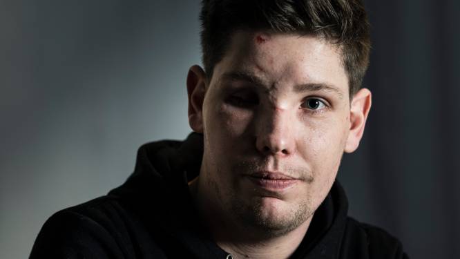 Illegale vuurwerkbom tekent Lars voor het leven: ‘Ik dacht altijd: dit gebeurt mij niet’