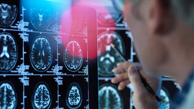 Nieuw medicijn remt Alzheimer volgens onderzoekers af