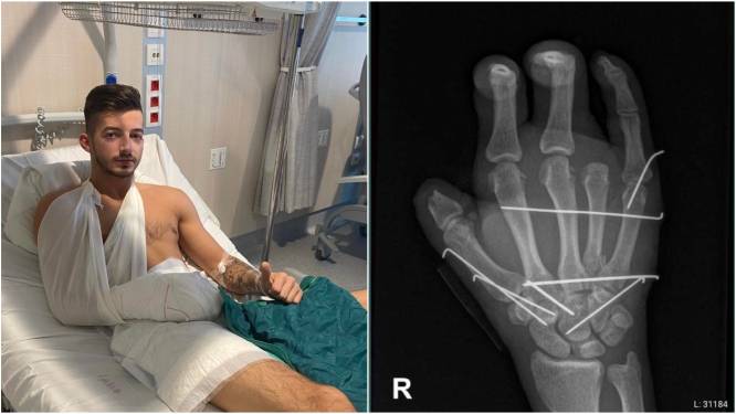 Jordy (23) verliest deel van hand tijdens coronabetoging, zus start crowdfunding voor prothese: “Ik dacht een fakkel op te rapen, maar het bleek een voetzoeker”