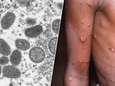 Hausse des cas de variole du singe: voici où se faire vacciner en Wallonie