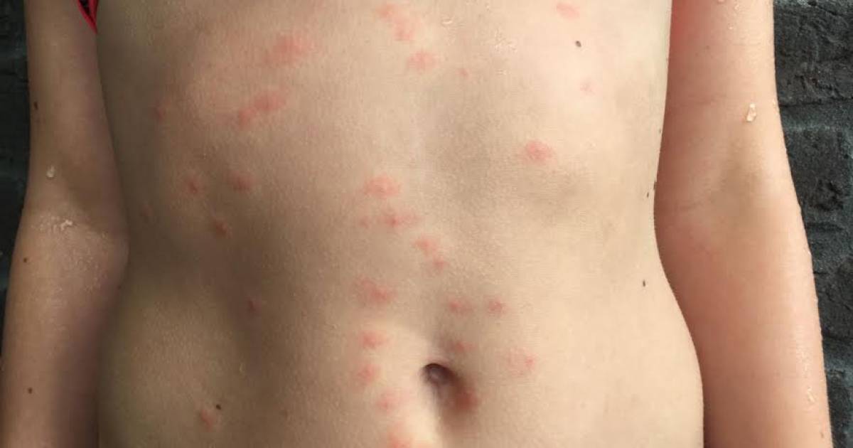 Waarschuwing voor zwemmersjeuk in recreatieplas bij Strandpark Slijk-Ewijk