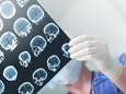 Britse neurologen waarschuwen voor zware herseninfecties bij patiënten met milde coronasymptomen