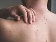 Goedele Liekens waarschuwt voor gevaren van melanomen: "Smeer en controleer”