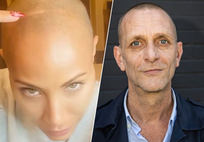 Onze reporter Sander Van den Broecke heeft net als Jada Pinkett-Smith alopecia.