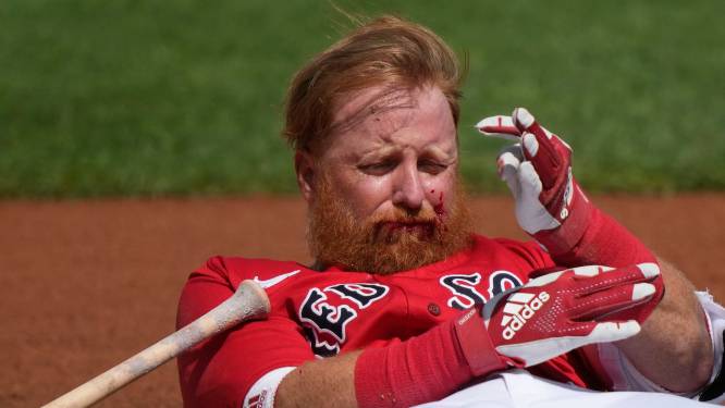 Honkballer Boston Red Sox krijgt bal met ruim 150 km per uur vol in gezicht