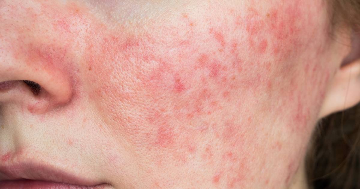Goneryl Interesseren Zwart Een geïrriteerde huid heeft vooral rust nodig.” Dermatoloog geeft voor elk  van de 7 soorten roodheid een oplossing | Instagram NINA | hln.be
