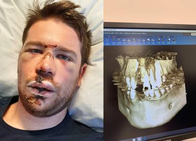 Fractures, dents cassées, bouches détruites: récits des dangers de la trottinette électrique