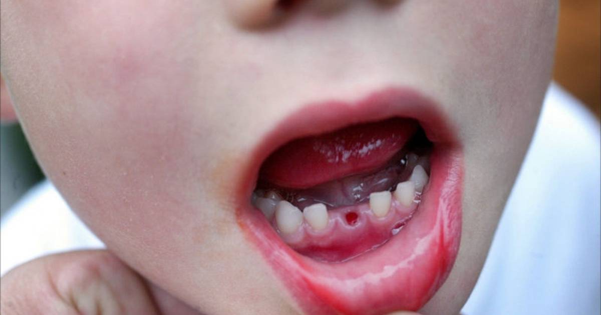 Claire aantal hek Tandartsen bezorgd over rotte tanden bij peuters en kleuters | Brabant |  bndestem.nl