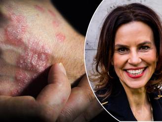 Expert over nieuwe psoriasismedicatie: "Resultaten zijn best spectaculair, maar niet iedereen komt in aanmerking "