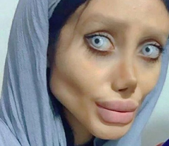 Iraanse 'Angelina' ligt aan beademing.