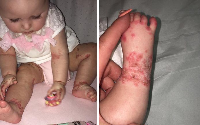 Milla (5 maanden), het dochtertje van Danielle MacIntyre, raakte in Mallorca besmet. Thuis brak de ziekte door en kreeg ze pijnlijke zweren.