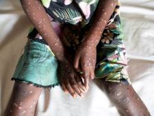 Apenpokken racistisch, WHO verandert naam virusinfectie