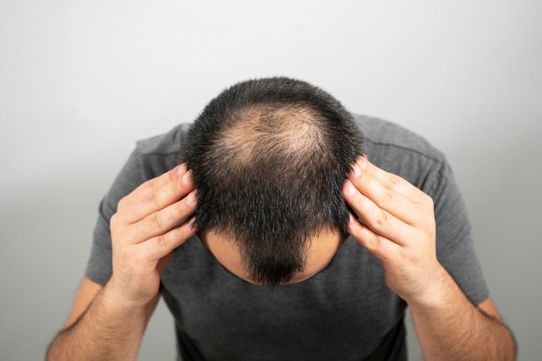 Dit is de reden waarom mannen kaal worden op hun kruin Beeld Getty Images/iStockphoto