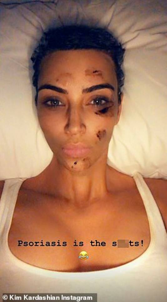 Kim Kardashian toont op haar Instagram haar gezicht na een Chinese kruidenbehandeling om psoriasis tegen te gaan.