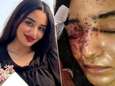 Iraanse veiligheidsdiensten mikken bij vrouwen specifiek op gezicht en intieme delen: “Zo willen ze hun schoonheid kapotmaken”