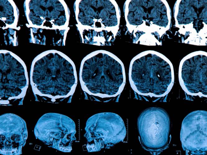 Nieuwe ontdekking is mogelijk doorbraak in behandeling van Alzheimer