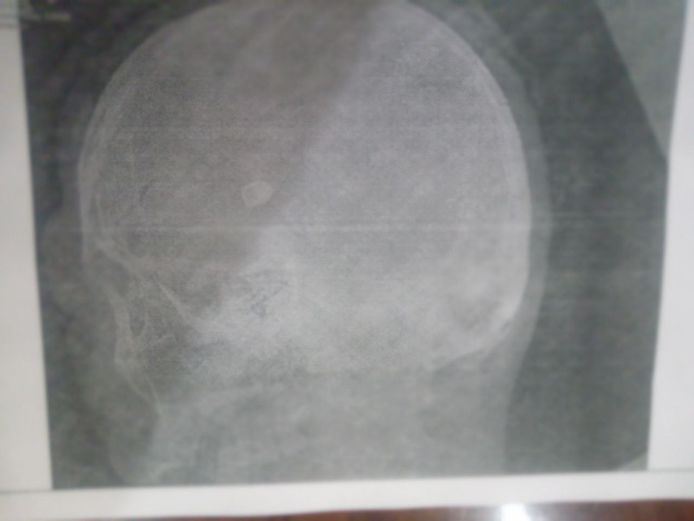 Een medisch beeld van de kogel in het hoofd van Mangoesjev.